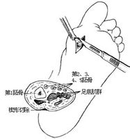 鸡眼切除术(图3)